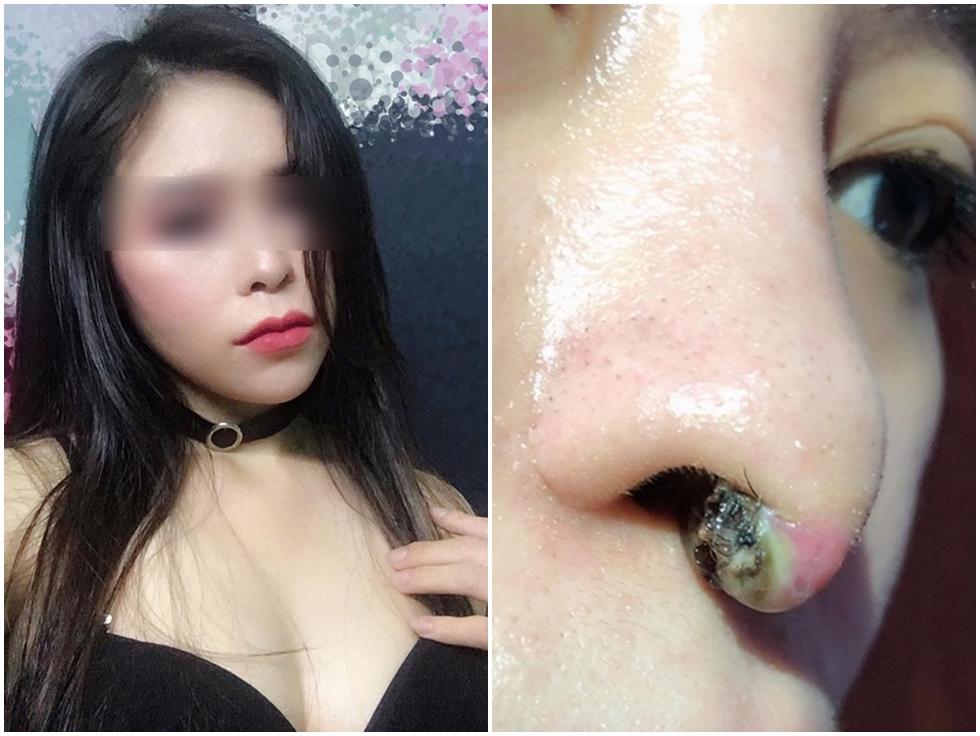 Tin tưởng phun xăm tại spa gần nhà và kết quả nhận lại là đôi môi sưng méo miệng, nổi mụn chi chít-8