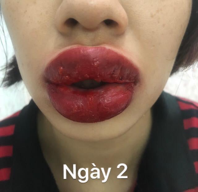 Tin tưởng phun xăm tại spa gần nhà và kết quả nhận lại là đôi môi sưng méo miệng, nổi mụn chi chít-4