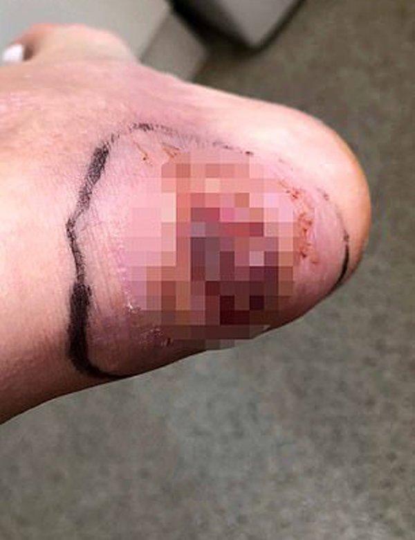 Bị thương khi đi giày có quai hậu, nữ người mẫu xinh đẹp suýt phải cắt chân-2