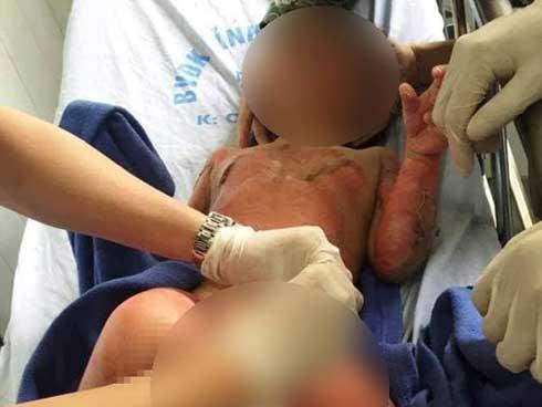 Vụ cô giáo đốt cồn dạy cháy nổ, 2 bé được ghép da-2