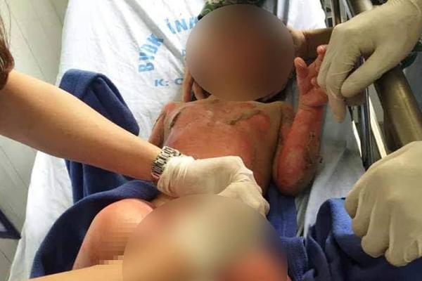 Vụ cô giáo đốt cồn dạy cháy nổ, 3 trẻ bị bỏng tiên lượng xấu-1