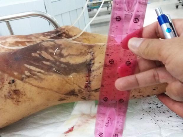 Việt kiều Canada bị cắt gân chân, tạt axit đến biến dạng khi chở bạn gái đi chơi giờ ra sao?-3