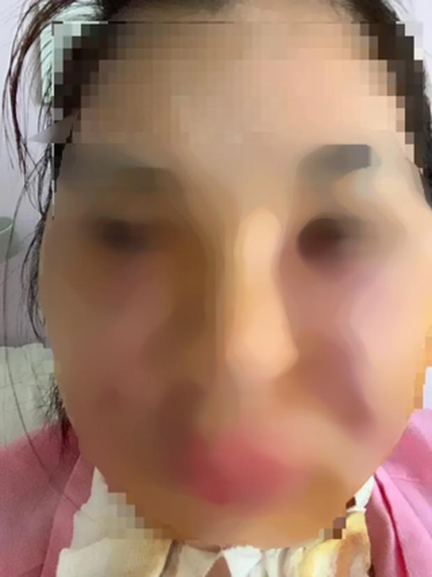 Mặt cô gái xinh đẹp bị rạch nham nhở vì rò mủ sau tiêm mỡ tự thân-1