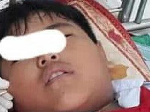 Hy hữu: Cây xiên que đâm xuyên mặt 1 học sinh lớp 4-1