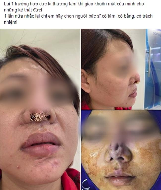 Gái xinh xuất hiện với chiếc cằm dài ngoằng, dân tình đoán già đoán non chắc do dao kéo quá đà đây mà-5