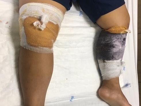 Trẻ 7 tuổi bị chó nhà hàng xóm lao vào tấn công gây 30 vết thương