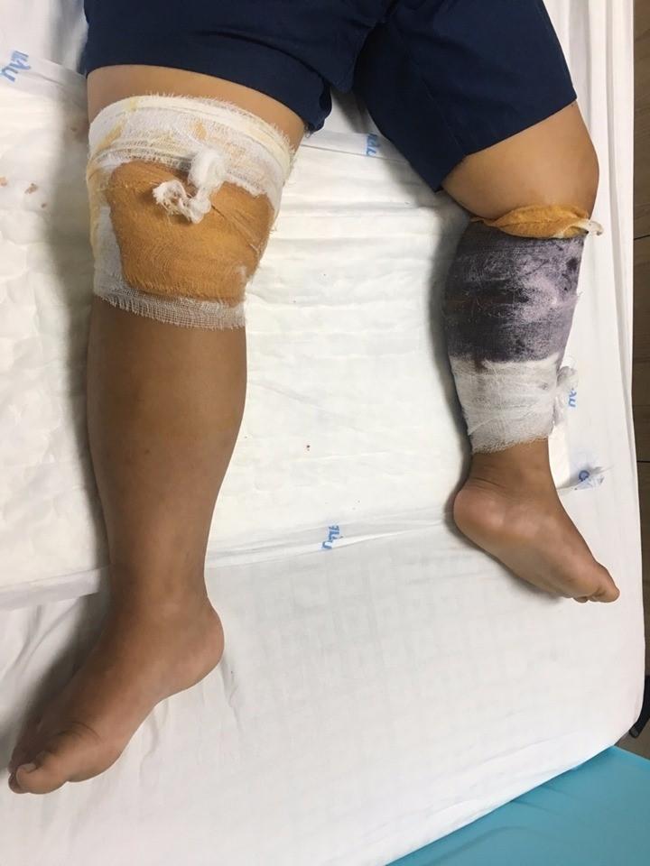 Trẻ 7 tuổi bị chó nhà hàng xóm lao vào tấn công gây 30 vết thương-1