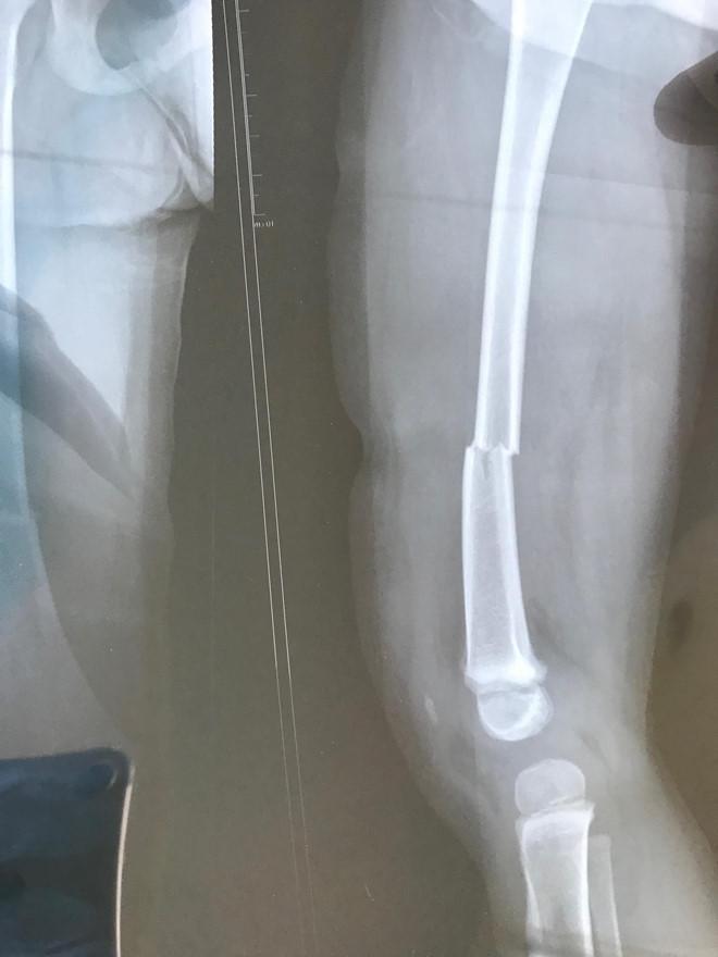 Con tôi gãy 1/3 xương đùi, hiệu trưởng vẫn bảo chệch khớp-2