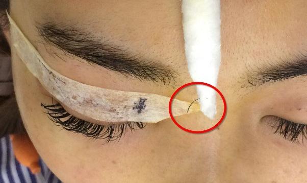 Nhấn mí ở spa, cô gái suýt mù mắt vì kim gãy, gần đâm thủng nhãn cầu-1