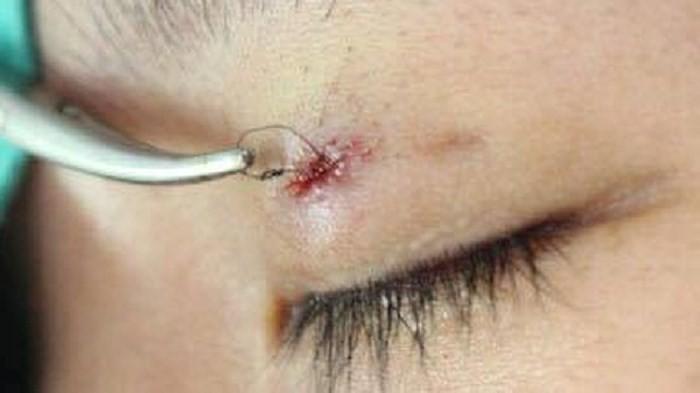 Nhấn mí ở spa, cô gái suýt mù mắt vì kim gãy, gần đâm thủng nhãn cầu-3