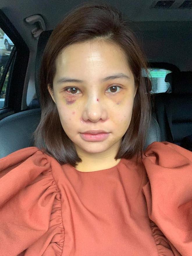 Lưu Đê Ly công khai phẫu thuật thẩm mỹ toàn bộ gương mặt-2