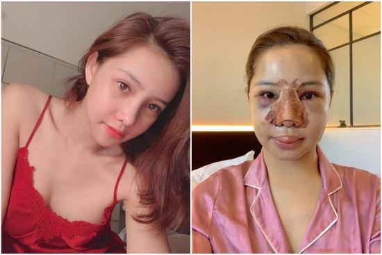 Lưu Đê Ly công khai phẫu thuật thẩm mỹ toàn bộ gương mặt