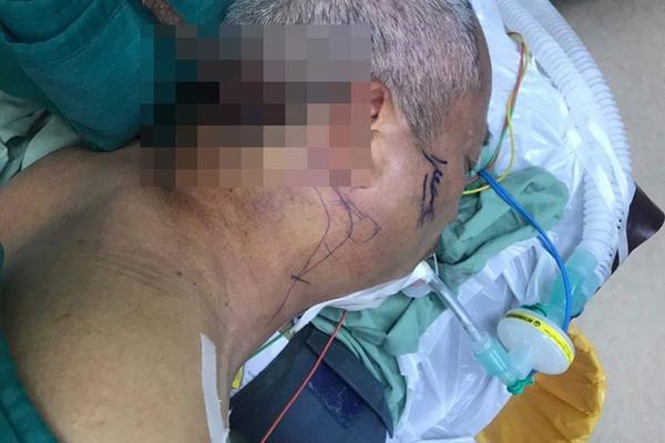 Phẫu thuật thành công cho nạn nhân bị cây sắt đâm xuyên cổ-1