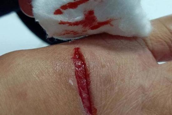 Người đàn ông ở Cà Mau tử vong sau 1 năm bị chó dại cắn