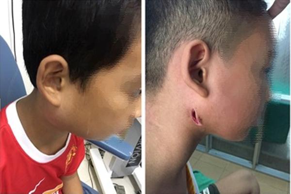 Vi khuẩn ăn thịt người tấn công nam bệnh nhân Thái Nguyên-2