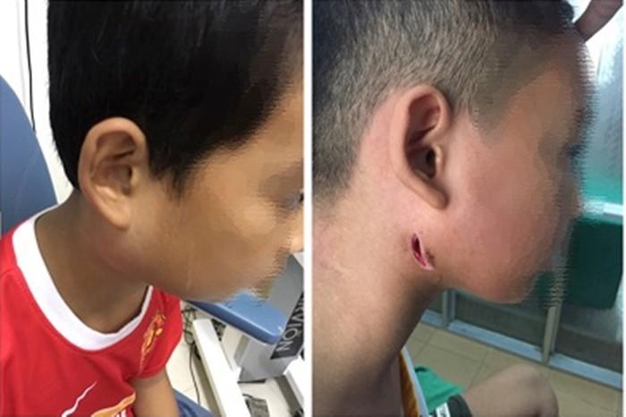 Phát hiện 3 trẻ ở Nghệ An nhiễm vi khuẩn ăn mòn cơ thể Whitmore-1