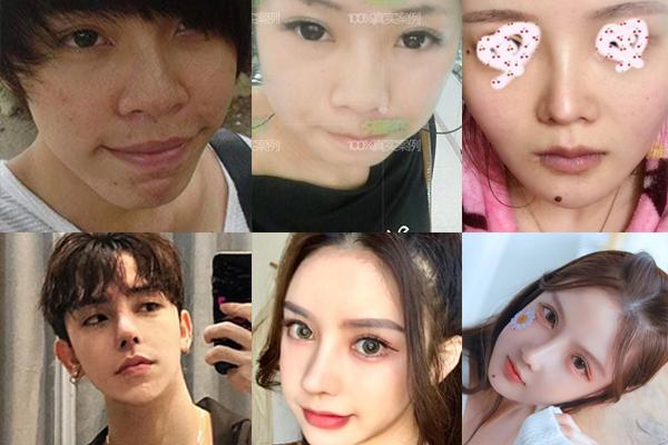 9X thay đổi hoàn toàn sau phẫu thuật thẩm mỹ bỏ hàm hô-4