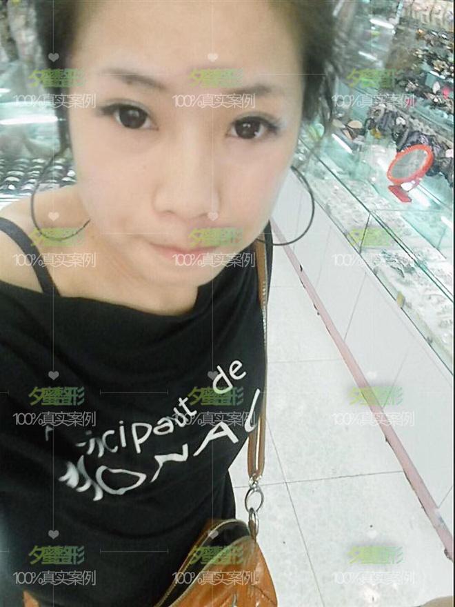 Trai xinh gái đẹp khiến ai nấy hết hồn khi khoe cận gương mặt giống nhau như tạc sau thẩm mỹ-2