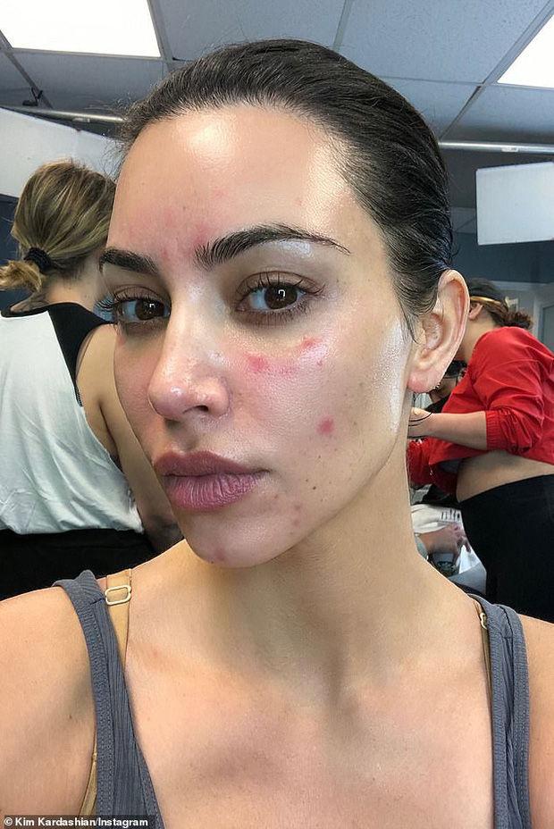 Kim Kardashian chia sẻ ảnh mặt mộc đầy vết tấy đỏ do căn bệnh vẩy nến để lại khiến ai nhìn cũng xót xa-1