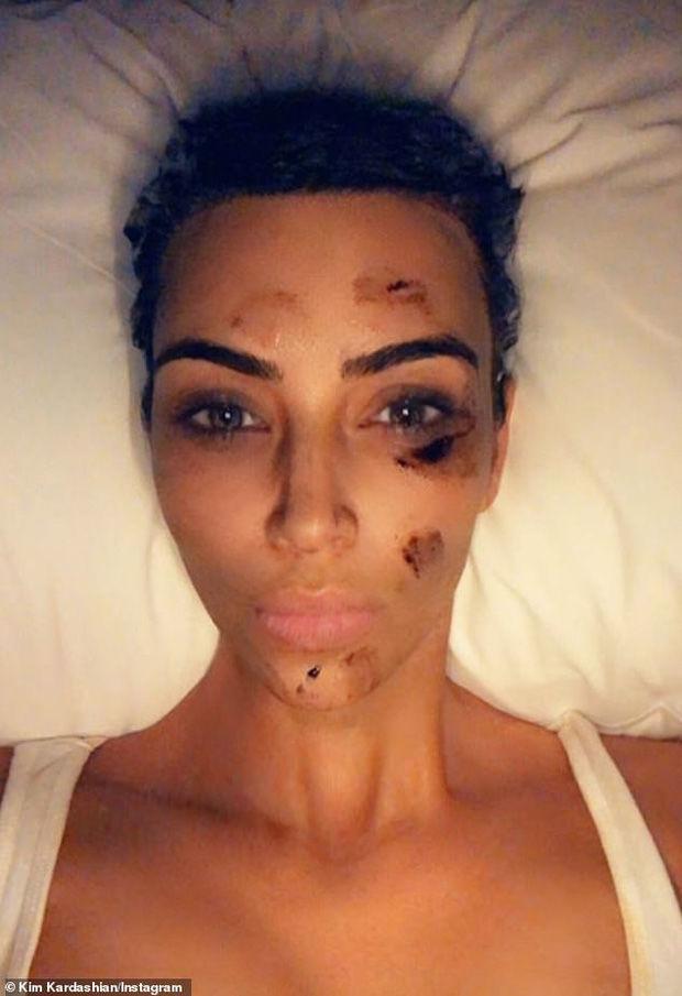 Kim Kardashian chia sẻ ảnh mặt mộc đầy vết tấy đỏ do căn bệnh vẩy nến để lại khiến ai nhìn cũng xót xa-2
