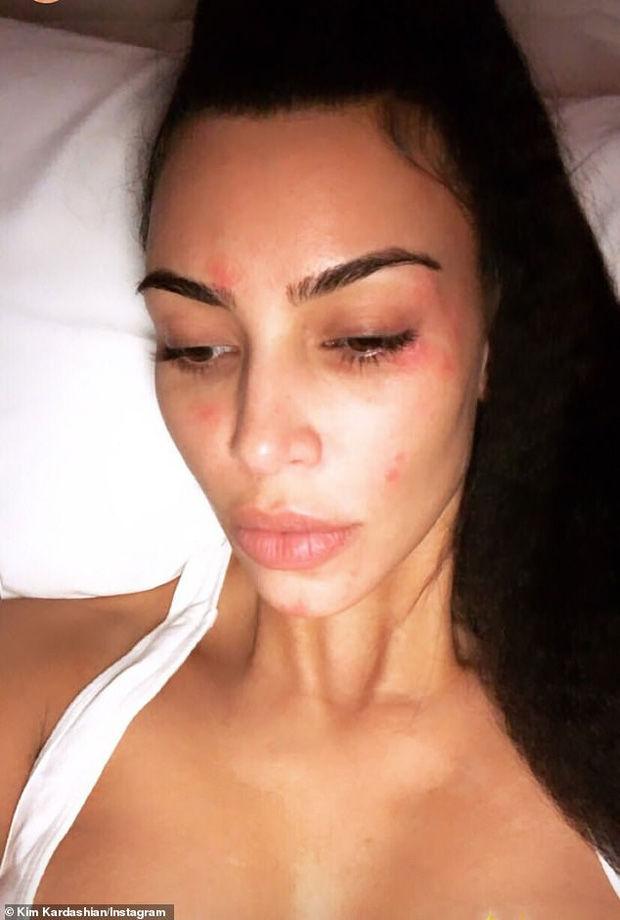 Kim Kardashian chia sẻ ảnh mặt mộc đầy vết tấy đỏ do căn bệnh vẩy nến để lại khiến ai nhìn cũng xót xa-3