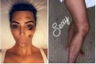 Kim Kardashian chia sẻ ảnh mặt mộc đầy vết tấy đỏ do căn bệnh vẩy nến để lại khiến ai nhìn cũng xót xa