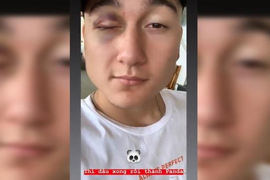 Văn Lâm khoe mắt thâm trên mạng xã hội