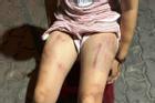 Xôn xao hình ảnh bé gái 6 tuổi bị bà cố nội đánh bầm tím khắp người