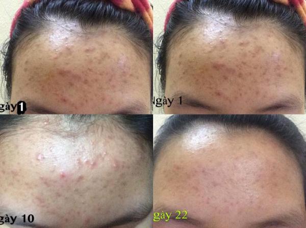 Bộ đôi đẩy lùi mụn cho da dầu-5