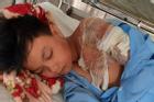 Bé trai 11 tuổi bị bỏng 60% vì cha tạt nước sôi