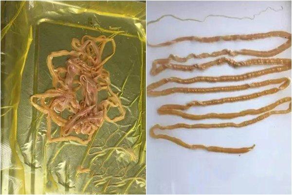 Người đàn ông thải ra sán dây 2.9 mét, loại thực phẩm này nhất định phải lưu ý-1