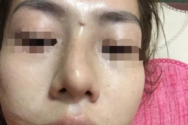 Giấu mẹ đi nâng mũi giá 2 triệu lại được trả góp, bé gái 13 tuổi ở Yên Bái bị mù một bên mắt-1