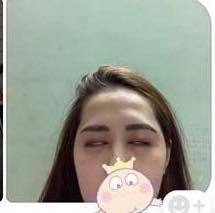 HÃI HÙNG: Liên tiếp những ca phẫu thuật thẩm mỹ hỏng mà cắt mí xong không nhắm nổi mắt-3