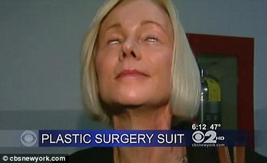 HÃI HÙNG: Liên tiếp những ca phẫu thuật thẩm mỹ hỏng mà cắt mí xong không nhắm nổi mắt-7