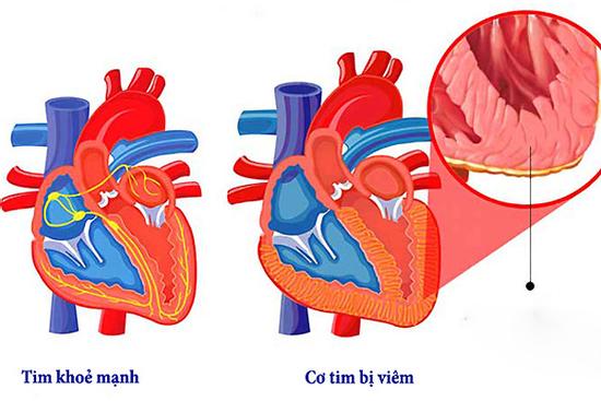 Sau 2 ca tử vong ở Hà Nội, bệnh viêm cơ tim nguy hiểm thế nào?