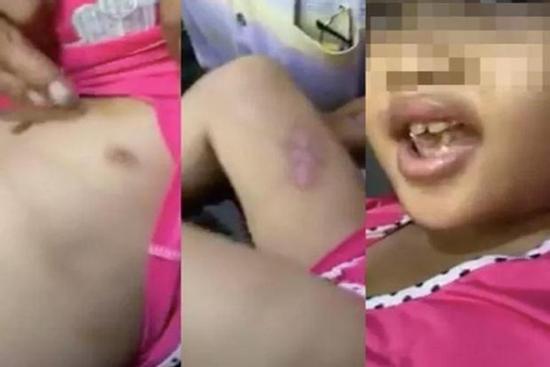 Mẹ và cha dượng nghi hành hạ, dí thuốc lá vào vùng kín của bé gái