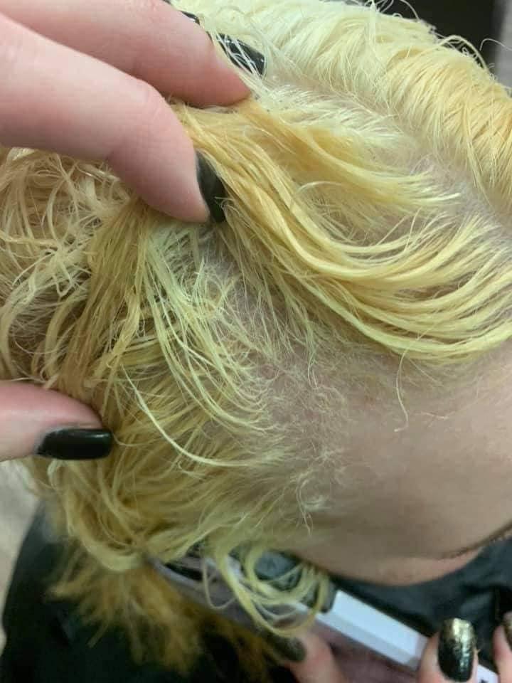 Nổi da gà với tình cảnh cô gái tẩy tóc bị rụng nguyên cả mảng đến mức hói đầu-3