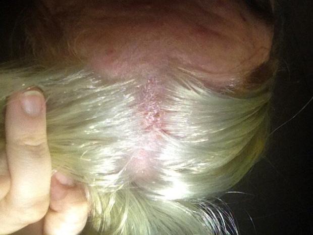 Nổi da gà với tình cảnh cô gái tẩy tóc bị rụng nguyên cả mảng đến mức hói đầu-7