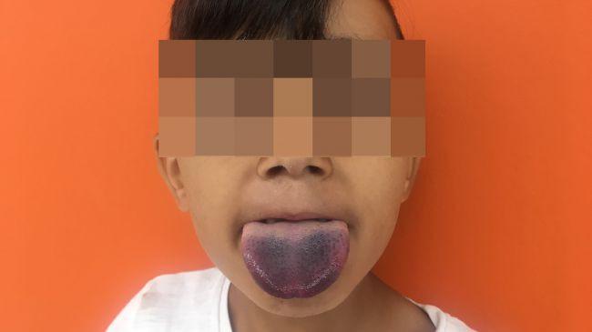 Cậu bé 7 tuổi phải nhập viện vì lưỡi mắc kẹt trong cổ chai-2