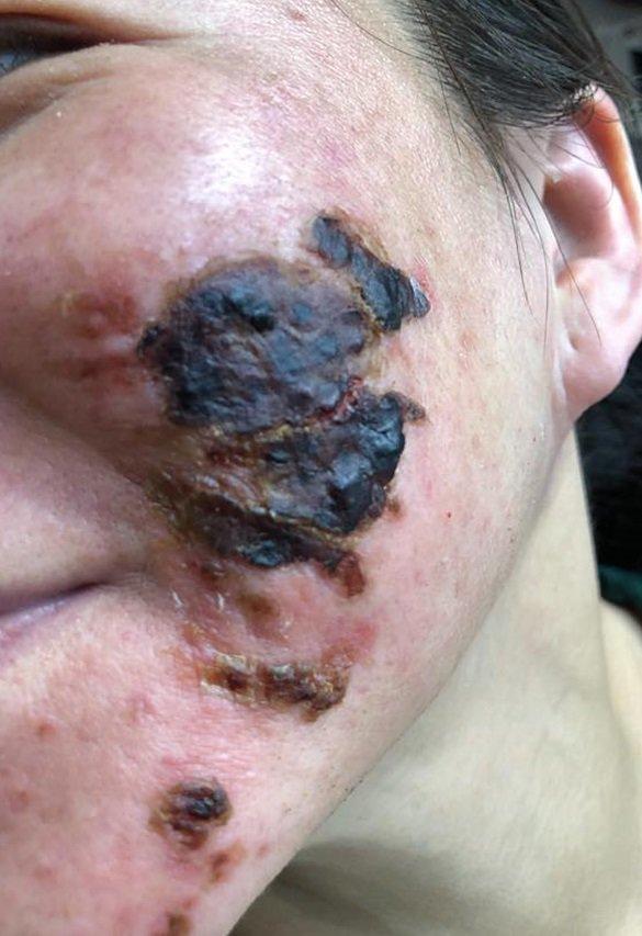 Khóc thét trước những gương mặt bị bỏng nặng sau khi lột da-1