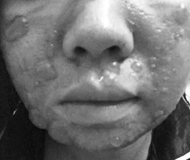 Khóc thét trước những gương mặt bị bỏng nặng sau khi lột da-3