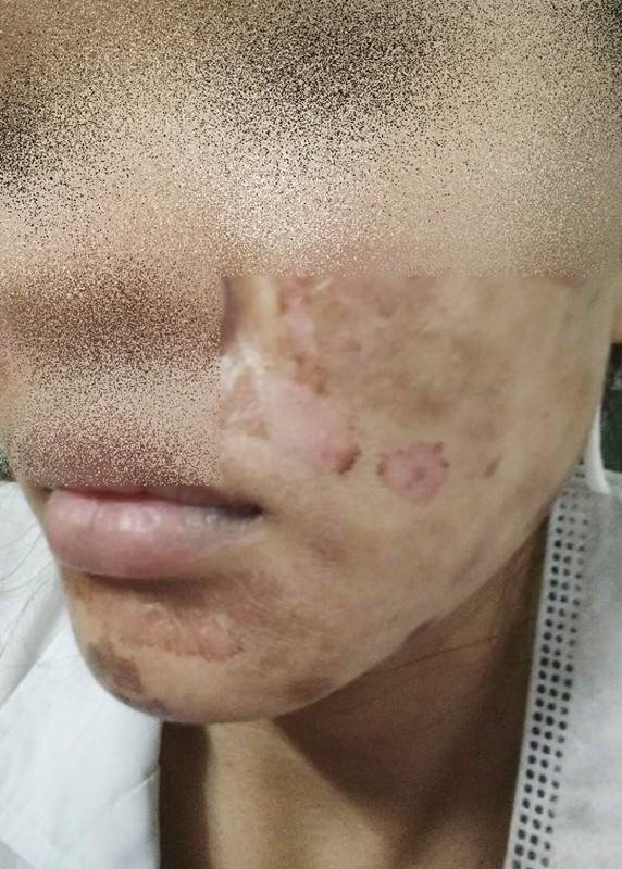 Khóc thét trước những gương mặt bị bỏng nặng sau khi lột da-5