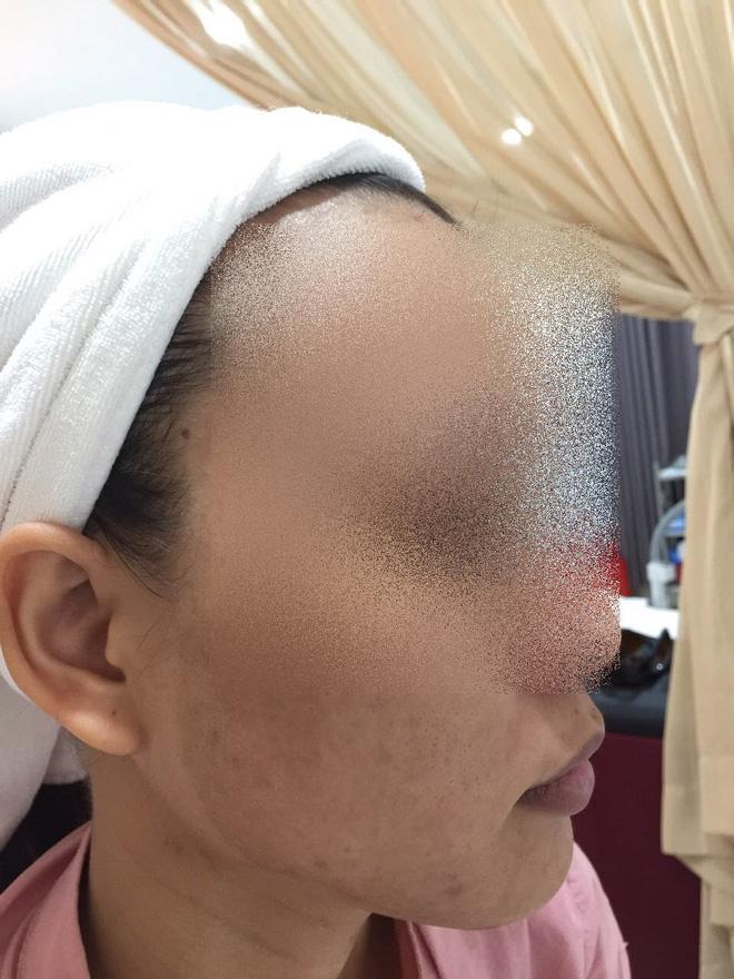 Khóc thét trước những gương mặt bị bỏng nặng sau khi lột da-6