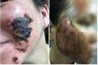 Khóc thét trước những gương mặt bị bỏng nặng sau khi lột da