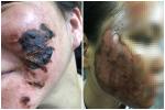 Khóc thét trước những gương mặt bị bỏng nặng sau khi lột da