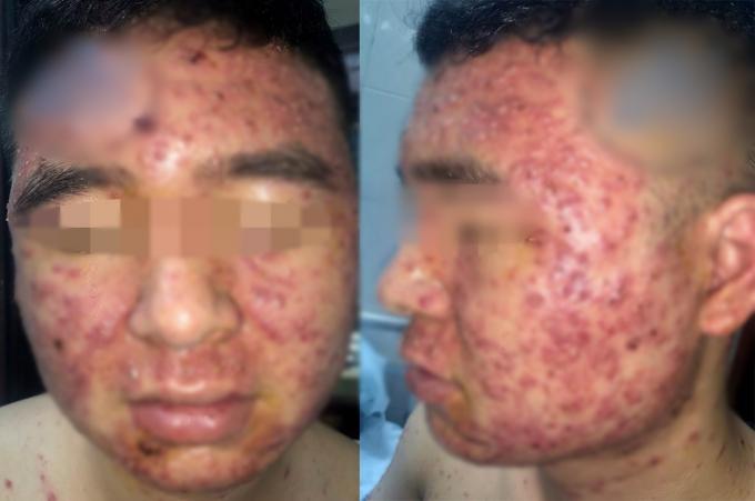 Chàng trai chi chít mụn mủ khắp mặt và người sau khi dùng thuốc nam bán trên mạng xã hội-1