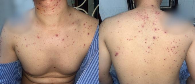 Chàng trai chi chít mụn mủ khắp mặt và người sau khi dùng thuốc nam bán trên mạng xã hội-2