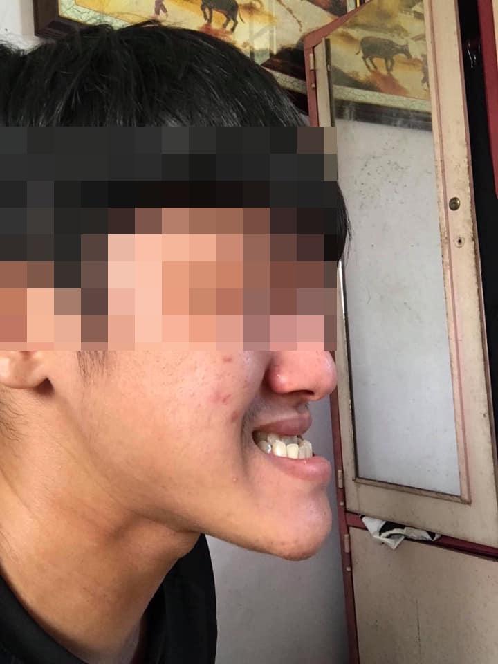 Sức mạnh vi diệu của phẫu thuật thẩm mỹ: Biến chàng trai cằm nhô dài ra phía trước trở thành soái ca-2