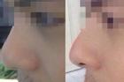 Người đàn ông có nguy cơ mù mắt sau khi tiêm filler nâng mũi làm đẹp
