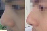 Phẫu thuật chui, người phụ nữ bị đứt lìa trụ mũi, thê thảm sau 12 ngày dao kéo-3